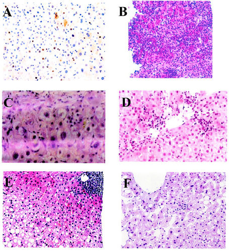 Figure 1 Hepatic histopathology image (Magnification 200×). (A) Hepatitis B Cases, (B) Chemical toxic liver injury, (C) Primary biliary cirrhosis, (D) Autoimmune hepatitis, (E) Non-alcoholic steatohepatitis, (F) Gilbert syndrome.