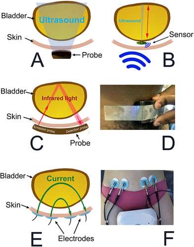 Figure 4 Volume monitoring devices: changes in bladder dimensions. (A) Geometries for ultrasound volume analysis. B-mode imaging with an array of transducers scanning a two-dimensional sector. (B) Theoretical model offering A-mode scans using an implantable single transducer. Ultrasound reflections from the front and rear walls of the bladder made it possible to estimate the volume with the antero-posterior diameter of the bladder (red arrow). An inductive link was used for both power transfer and data telemetry with the implanted unit. Data from Mandal S et alCitation42 (C) Near infrared spectroscopy technique using light sources of approximately 975 nm to detect variations in the water content and oxygenation status and hemodynamics of the bladder. By placing the emission and detection probes on opposite sides of the bladder, an increase in bladder volume results in a decrease in the detected-light intensity and makes it possible to estimate the volume. (D) Positioning of the wearable device over the bladder using the bony landmark of the symphysis pubis. Reprinted from Stothers L, Macnab A, Mutabazi S, Mukisa R, Molavi B, Shadgan B. Near-Infrared Spectroscopic Screening for Bladder Disease in Africa: Training Rural Clinic Staff to Collect Data of Diagnostic Quality. Journal of Spectroscopy. 2016;2016:1241862.Citation43 (E) Bioimpedance. Using electrodes, the passage of a small alternating current across tissues is opposed by body tissue impedance. Volume estimations are based on the measured parameters. (F) Tetrapolar bioimpedance measurements carried out on a volunteer. Adapted from Gaubert V, Gidik H, Koncar V. Proposal of a Lab Bench for the Unobtrusive Monitoring of the Bladder Fullness with Bioimpedance Measurements. Sensors (Basel). 2020;20(14):3980.Citation44