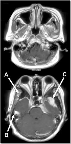 Figure 1 The brain MRI showed multiple enhancing lesions at right sphenoid wing (A), right temporal (B), and left sphenoid wing (C) with hyperostosis of bone in the right sphenoid wing.