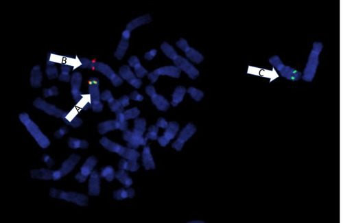 Figure 2 Metaphase FISH using break apart probes for 3ʹPDGFRB (red signal) and 5ʹPDGFRB (green signal). Arrow A shows the normal chromosome 5 with an intact PDGFRB fusion signal (yellow). Arrow B shows the derivative chromosome 5 containing only the 3ʹ portion of PDGFRB (red signal). Arrow C shows the derivative chromosome 7 with the translocated 5ʹ portion of PDGFRB (green signal).