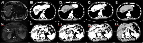 Figure 5 Abdominal MRI and CT images before and after treatment. The time of MRI was (Ai–Aii) 2022-07-25, the time of CT was (Bi–Bii) 2022-09-14, (Ci–Cii) 2022-10-17, (Di–Dii) 2023–02-08, (Ei–Eii) 2023-06-28. (white arrow indicate liver masses).