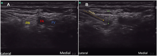 Figure 1 Femoral nerve block: (A) FN femoral nerve. FA femoral artery. FV femoral vein. (B) LA local anesthetic.