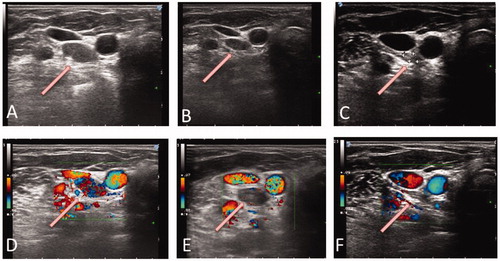 Figure 3. Neck ultrasound follow-up after LA. (A, B, C) Progressive volume decrease of the LA-treated lesion (A: at baseline; B. at 5 months; C: at 12 months). (D, E, F) Color-Doppler examination showed the marked decrease and, successively, the disappearance of the vascular signals within the treated area (D: at baseline; E: at 5 months; F: at 12 months). In all images, the arrows point toward the pathologic lymph-node.