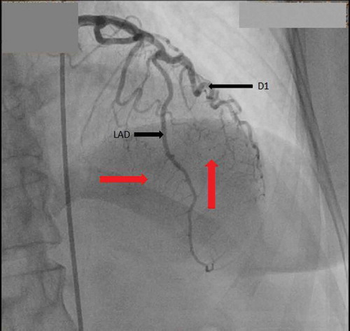 Figure 2. Coronary angiography showing multiple microfistulae arising from distal end of LAD and 1st diagonal branch of LAD emptying into left ventricle (red arrows).