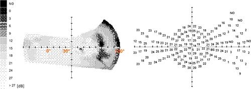 Figure 1 Temporal border of the visual field with a displacement of the fixation point nasally by 40 degrees.