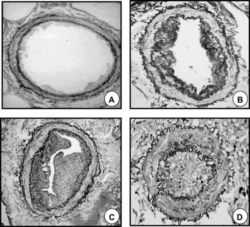 Figure 2 Remodeling of pulmonary muscular arteries in pulmonary hypertension. (A) Pulmonary muscular artery of a control subject without COPD. (B) Pulmonary muscular artery with a moderately remodeled intima in a patient with COPD and mild pulmonary hypertension. (C) Pulmonary muscular artery with a highly enlarged intima from a patient with COPD and severe pulmonary hypertension. (D) Pulmonary artery showing a prominent muscular hypertrophy in a patient with pulmonary arterial hypertension.