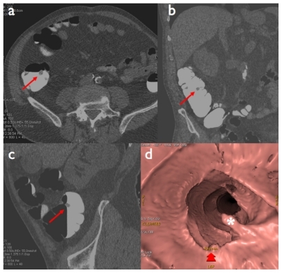 Figure 5 Pedunculated polyp of the ascending colon: a) native axial image, b) coronal reformation, c) sagittal reformation (red arrows), d) virtual endoscopic view (white asterisk).