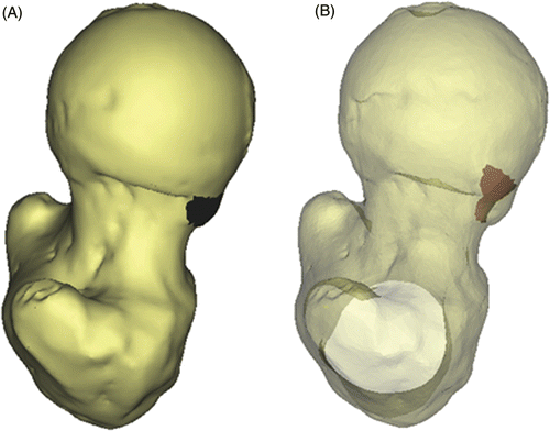 Figure 1. (A) Craniocaudal view of femur with cam-type lesion (dark blue area) as detected by morphological analysis, and (B) suggested surgical correction to be obtained (red area).
