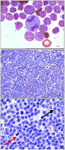 Figure 1 (A) Cytology of dog diagnosed with multicentric lymphoma. Note the presence of atypical lymphocytes with basophilic cytoplasms, loose chromatin, anisocytosis, apparent nucleoli ‘N’, and cell mitosis ‘M’ (BAR: 20 µm). (B) Photomicrograph of diffuse large canine cell lymphoma (BAR: 25 µm), and (C) a magnified version of image B. Note lymphoid cells with large nuclei (black arrow) and distinct nucleoli. Note the mitotic cells (red arrow) (B and C).