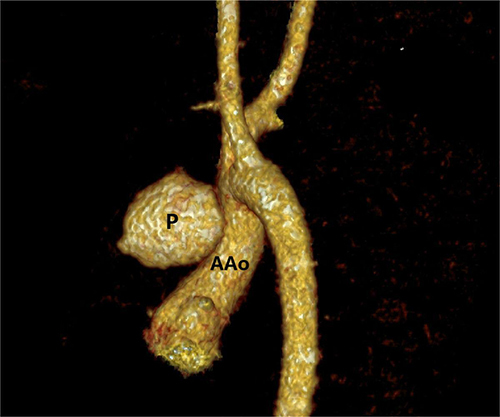 Figure 5 Three-dimensional reconstructed CTA image showing a large, sac-like protrusion on the left anterior wall of the mid-ascending aorta.