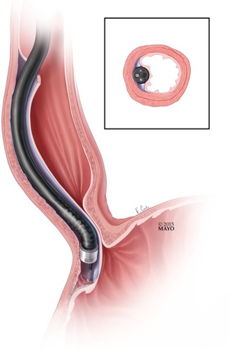 Figure 1 Endoscope inserted and used to create submucosal tunnel.