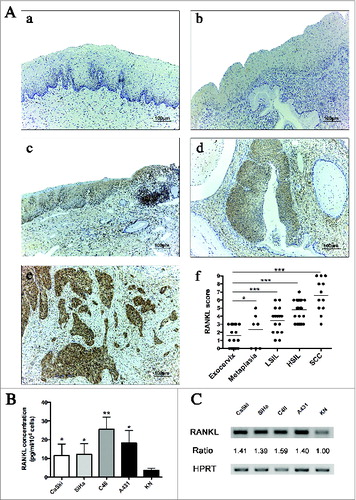 Figure 2. Squamous carcinoma cells express RANKL in vitro and in situ. (A) RANKL expression in cervical biopsy specimens. (a) Normal exocervix, (b) squamous epithelial metaplasia, (c) low-grade squamous intraepithelial lesions, (d) high-grade squamous intraepithelial lesions, (e) cervical SCC. Original magnification: X100. The RANKL immunoreactivity is observed in the epithelial compartment. (f) Semi-quantitative evaluation of RANKL expression in normal exocervix (n = 22), epithelial metaplasia (n = 9), LSIL (n = 18), HSIL (n = 27) and SCC (n = 12). Asterisks indicate statistically significant differences (*P < 0.05; ***P < 0.001). (B) RANKL secretion by SCC cell lines (SiHa, CaSki, A431, C4II) and normal keratinocytes (KN) was determined by an ELISA assay. Data represent mean ± standard deviation of RANKL concentration (pg/mL/106 cells) from five independent experiments (*P < 0.05; **P < 0.01). (C) RANKL mRNA expression by SCC cell lines (CaSki, SiHa, C4II, A431) and KN was determined by classical PCR. Densitometric analysis (ratio) shows that RANKL mRNA level is higher in SCC cell lines compared to KN.