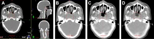 Figure 1 Image registration by automatic bone matching and manual fine-tuning method in head.
