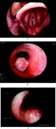 Figure 1. (a) Laryngeal papillomatosis. (b) Endobronchial solitary papilloma. (c) Tracheal papillomatosis.