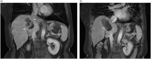 Figure 3. An example of a complete response for HIFU ablation. The patient is a 54-year-old female with liver metastasis from colon cancer. The contrast-enhanced MRI showed that pre-procedure hepatic lesion located between 1st and 2nd porta (white arrow) (a) and complete non-perfused area (white arrow head) of the whole tumor after HIFU ablation (b).