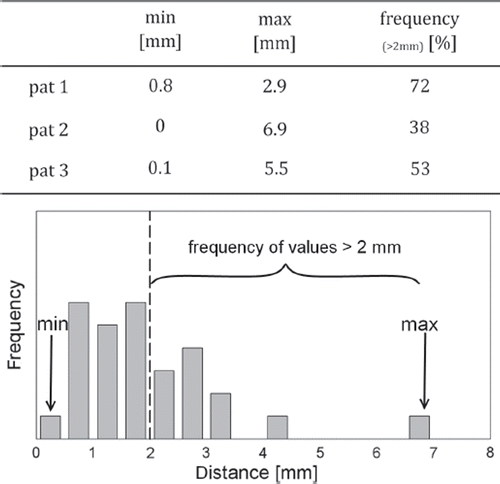 Figure 3. Magnitude of the difference of the vectors resulting from a registration of the small and the large registration box. Upper panel: Presented is the range (min, max) of the distribution over all fractions. Additionally shown is the frequency in percent of the fractions with a difference bigger than 2 mm between both couch shifts. Lower panel: Exemplary illustration of the differences of these vectors for patient 2.