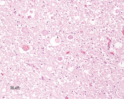 Figure 4 Photomicrograph of the spinal cord taken at C1. Scattered small to medium spheroids and axonal swelling are indicators of axonal degeneration (arrow). Artifactual spongiosis is present. Hematoxylin and eosin stain; bar =50 μm.