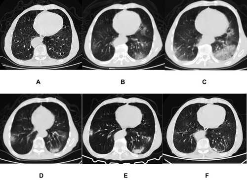 Figure 2 A 73-year-old man who exposed to COVID-19 patients has fever and fatigue for 2 days. The initial chest CT is negative (A). After 2 days, the first repeat CT shows multiple patchy GGOs with heterogeneous density developed in the bilateral lungs (B). Subsequently, some of new lesions increase in extent and density (C), and then absorbs gradually with decrease of extent and increase of density (D and E). On the latest CT scan (38 days later), they significantly absorb and leave few fibrous strips (F).