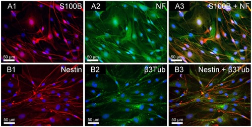 Figure 3 Immunofluorescence double staining of NOM cells cultured for 21 days in 2D stationary culture, prior to their seeding in the magnetic fibrin scaffolds. (A1) S100B (glia marker in red); (A2) NF (neuronal marker in green); (A3) merge of S100B and NF. (B1) Nestin (neuronal precursor marker in red); (B2) β3Tub (neuronal marker in green); (B3) merge of nestin and β3Tub. The nuclei of the cells were dyed in blue with DAPI.Abbreviations: NOM, nasal olfactory mucosa; 2D, two-dimensional; S100B, 100% soluble calcium-binding protein B; NF, neurofilament; β3Tub, beta III tubulin; DAPI, 4′,6-diamindo-2-phenylindole.