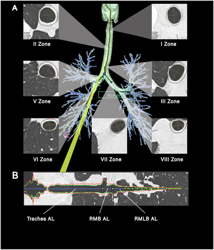 Figure 1. Diagram of central airway measurement. (A) A three-dimensional reconstruction of the tracheobronchial tree from a 25-year-old female, presenting cross-sectional views of zones I-III and V-VIII. Annotations in the lower left corner of each section provide the mean airway wall thickness (AWT in mm) and airway luminal area (ALA in mm2). Subcarinal angle (SCA in degrees) is denoted in the green box, measured at 80.9 degrees; (B) a longitudinal cross-section matched to the yellow line in (a), with the blue line marking the measurement path along the airway’s length. Progressing from the left, the first yellow marker on the blue trajectory signifies the division into the right and left main bronchi, the second marker signals the entry to the right lung’s upper lobe, and the third marker delineates the convergence points to the right lung’s middle and lower lobes. ‘AL’ refers to airway length, ‘RMB’ is an abbreviation for the right main bronchus, and ‘RMLB’ represents the right middle lobar bronchus.