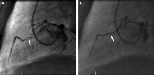 Figure 2.  (A) Left coronary angiogram in lateral projection after stent implantation (black arrow) in the proximal LAD showing a prominent myocardial bridge (white arrow) in the mid-LAD during systole (B) Same view during diastole showing no compression of the vessel (white arrow).