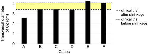 Figure 6. Transversal diameters of the coagulation zones computed for the considered cases A–F. Horizontal lines are the mean transversal diameter found in the clinical trials (dashed line) and the “corrected value” by taking the shrinkage effect into account (dotted line). The coloured band thus represents the range in which the clinical and computed results would match.