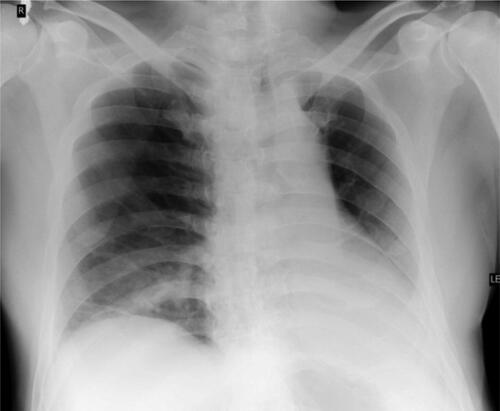 Figure 2. Chest radiography. Inflammatory pneumonitis in the right basal lung. Hypoventilated surrounding parenchyma. Cardiac shadow with elongated left ventricular arch.