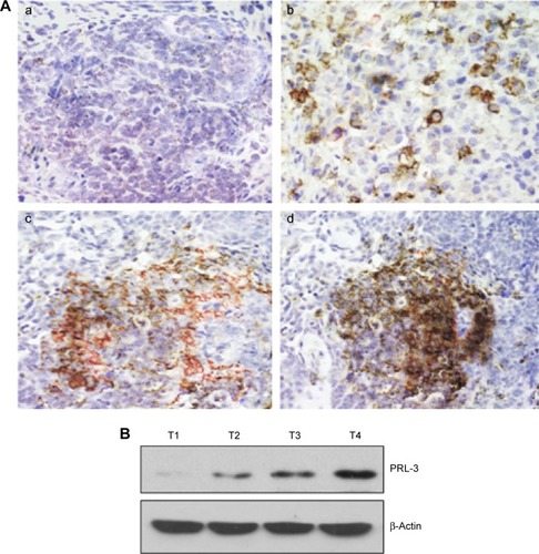 Figure 1 PRL-3 expression in FH Wilms’ tumor tissues.