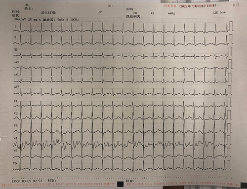 Figure 2 Electrocardiography of the patient showing sinus tachycardia about 24 hours after taking clozapine.