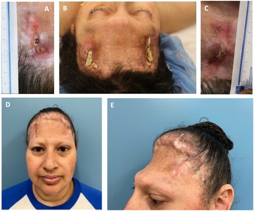 Figure 2. (A–C) Baseline images prior to initial mVASC treatment. At this point, the perimeters of the wounds were lightly debrided to remove necrotic tissue and encourage punctate bleeding. One vial of mVASC was rehydrated in 1.5 cc of sterile water, with equal amounts then injected into the soft tissue immediately surrounding both wound sites. A non-adherent dry dressing (adaptic touch, systagenix, Gatwick, United Kingdom) was applied over the wounds. (D–E) Residual wounds healed after mVASC treatment, following spontaneous separation of necrotic bone sequestra and wound surface reepithelialization.