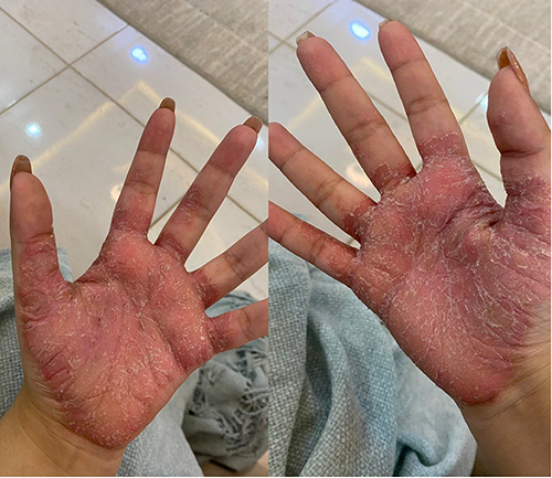Figure 1 Well-defined thick erythematous scaling plaques involving both palms of the patient.