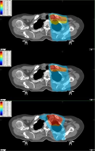 Figure 1 Dose distribution of 1.5 cm and 3.0 cm depth dose prescriptions and intensity modulated radiotherapy.