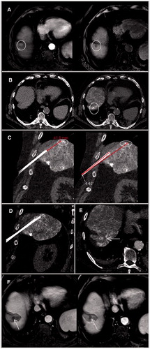 Figure 2. Dynamic T1-weighted MR sequences with contrast administration in arterial (left) and venous (right) phases showed a small (1 cm) segment VIII lesion with typical pattern of HCC, in a cirrhotic patient of 73 year old A. The lesion was not visualized on US and unenhanced CT (left). An intra-arterial hepatic injection of iodized oil (Lipiodol) was performed to make the lesion detectable (right) B. A one-plane trajectory access was impossible on CT-guidance. Therefore, a RF electrode was inserted using EMN and HFJV. A first-pass control CT (coronal reconstructions) was performed before the target had been reached to confirm both the correct path of the applicator and the distance we needed to advance C. The probe was then advanced accordingly on EMN until the target was reached, as confirmed on coronal pre-ablation CT acquisition D. A single ablation was performed and cauterization of the electrode track had been used. Axial post-ablation CT confirmed an ablation area that covered the entire lesions E. Three-month (left) and 6-month (right) contrast enhanced MRI confirmed a complete ablation without residual enhancement F. HCC: hepatocellular carcinoma; CT: Computed Tomography; EMN: electromagnetic navigation; HFJV: high-frequency jet-ventilation; RF: radiofrequency.