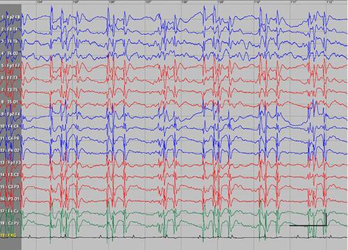 Figure S4 Absence status epilepticus in patient 5. Vertical bar - 100uV, horizontal bar - 1 sec.