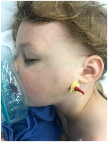 Figure 2. Clinical photograph intra-operatively showing the 2.8 mm threaded Steinman pin placed from left mandibular angle to right mandibular angle with a red rubber catheter with a xeroform dressing placed over the external portion of the pin for protection.