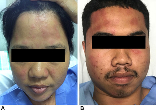 Figure 4 Isolated facial urticaria observed during the challenge in patients with adult-onset IgE-mediated wheat allergy. (A) A wheat-allergic patient during the open wheat challenge (day 2). (B) A wheat-dependent exercise-induced anaphylaxis patient during the combined wheat-cofactors challenge (day 3).