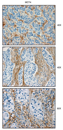 Figure 4 MCT4, a marker of aerobic glycolysis and lactate efflux, is elevated in the stroma of human breast cancers. Paraffin-embedded sections of human breast cancer samples lacking stromal Cav-1 were immuno-stained with antibodies directed against MCT4. Slides were then counter-stained with hematoxylin. Note that MCT4 is highly expressed in the stromal compartment of human breast cancers that lack stromal Cav-1. Three representative images are shown. Original magnification, 40x and 60x, as indicated.