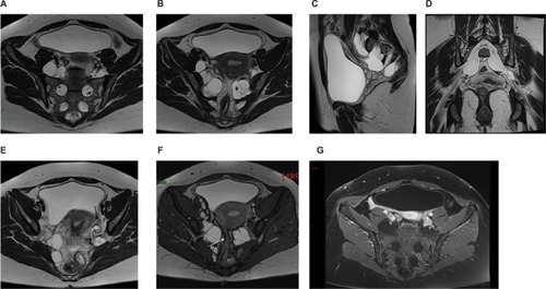 Figure 1 MRI of giant multiple tarlov cysts. Axial (A and B), sagittal (C), and coronal (D) images: Multiformat Reformation (MPR) from 3 Dimensional T1 MRI sequence. MRI revealed 8 tarlov cysts (size: 30–63 mm) multilocular with bone erosion of the left posterior S2 vertebral body. The development of the cysts is well visible on sagittal (C) and oblique (D) views. In (A) and (B), the cysts enter the presacral space through the enlarged right and left S1–S2, S2–S3, and S3-S4 foramina. The cysts are seen as homogenous hypointense signal masses on T1-weighted image and as hyperintense signal masses on T2-weighted image. All the cysts are multiseptated: the septa (A, B: short arrows) as the nerve roots (A, long arrow) coursing within are well identified on T2 images. A cyst (E, short arrow) is seen lateral to the left ovary (E, long arrow) and another one is responsible for a compression of the sigmoid (F, arrow). (G) The multiple cysts do not enhance after gadolinium chelate administration. The cysts enter the presacral space through the right and the left enlarged S1–S2, S2–S3, and S3–S4 foramina.