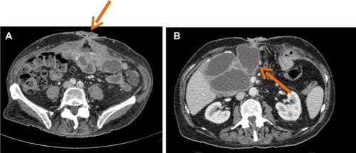 Figure 7 Abdominal computed tomography scan of a patient with evidence of actinomycosis on pathology.Notes: Enterocutaneous fistula (arrow) (A) was associated with large intra-abdominal abscess (arrow) (B).