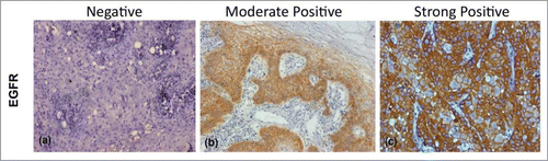 Figure 1. Figure showing Immunohistochemical expression of EGFR in OSCC (A) showing negative cytoplasmic and membranous staining (B) showing moderately positive cytoplasmic and membranous staining (C) showing strongly positive cytoplasmic and membranous staining (DAB x 125 x digital magnification).
