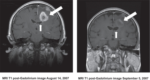 Figure 5 MRI scans showing a typical response of a recurrent GBM to bevacizumab. The image on the right shows the tumor-associated enhancement (large arrow) and accompanying compression of the ventricle by mass effect (small arrow). The image on the right shows the same region following a one month course of bevacizumab. Note the marked reduction in contrast enhancement and mass effect.