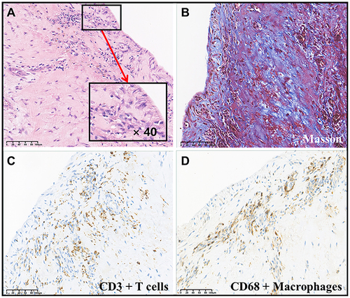 Figure 7 Endocardial fibrosis of the end stage of Loeffler endocarditis. (A) Endocardial fibrosis with H&E stain (×400); (B) Blue Fibrotic layer with Masson Trichrome stain (×200); (C–D) T cells and macrophages infiltration with immunohistochemical (IHC) stain (×200).