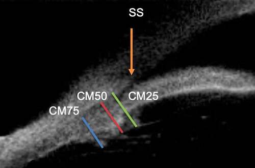 Figure 3. Figure depicting ciliary muscle thickness at the levels of CM25, CM50 and CM75, as the width of the muscle determined at points that fell 25%, 50% and 75% of the total length posterior to the scleral spur. SS:scleral spur.
