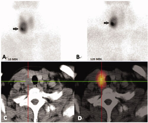 Figure 3. Images from a 41-year-old female diagnosed with PHPT. Her serum levels of iPTH and calcium on admission were 726.80 pg/mL and 2.97 mmol/L, respectively. (A, B): Dual phase 99mTc-MIBI planar scintigraphy of the parathyroid glands, (A) 10min, (B) 120 min. CT alone (C) and SPECT/CT (D) of the same cross-section, showing the right inferior parathyroid. The best diagnostic performance is achieved by combination of a detailed morphological image (CT) and functional, scintigraphic map (SPECT/CT).