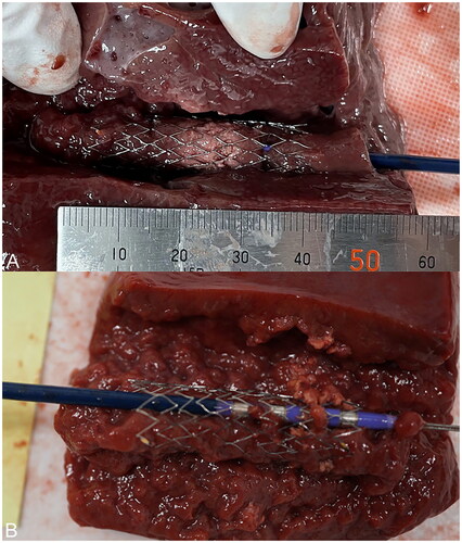 Figure 4. After ablation, the block was cut longitudinally using a pathology knife to expose the stent. A sufficient ablation effect within the stent can be confirmed in the ingrowth-ablation model (A), while the tissue is hardly ablated in the ingrowth-ablation with stent-wire contact model (B).