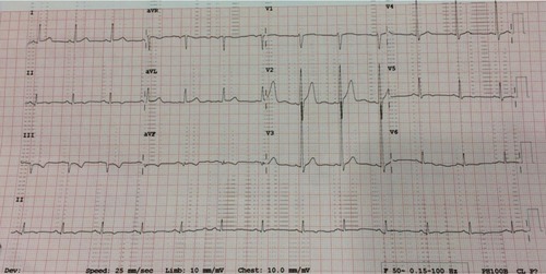 Figure 2 Electrocardiogram on the day of patient discharge.