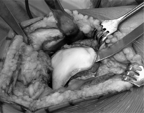 Figure 1. Intraoperative finding of a flat trochlea before peeling of the cartilage.