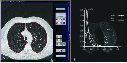 Figure 1. (A) Upper slice (at the superior border of the aortic arch) transferred to the post-processing workstation, where quantitative lung density analysis was performed using the Pulmo CT program. (B) Histogram of distribution of lung attenuation values, measured in HU in the upper slice (at the superior border of the aortic arch) for several potential emphysema thresholds.