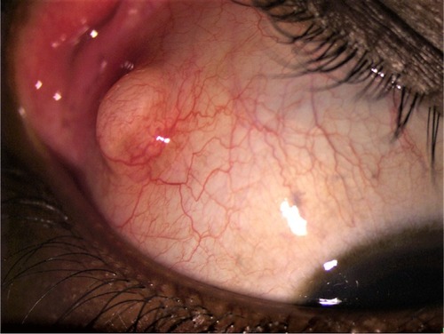 Figure 1 The subconjunctival mass with surrounding vascularization.