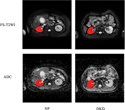 Figure 2 Respective MR images of the right kidney with stage III type 2 DKD and normal persons (NP). The ROI were curved over the renal parenchyma of the right kidney (red curve). In this study, the images analyzed were the FS-T2WI and ADC maps. (Female patient with DKD, 54 years old, stage III diabetes nephropathy, creatinine value was about 135.7, BMI index was 28.41).